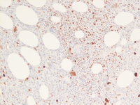 P53 Immunostain in t-MN/MDS