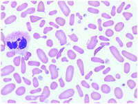Sickle cell- beta thalassemia