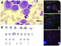 The beauty and the beast: lymphoma-like morphology of myeloid blast phase in CML