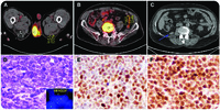 Philadelphia chromosome–positive B-lymphoblastic lymphoma involving the genitourinary system and bone at initial diagnosis and relapse