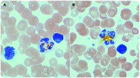 Bilirubin inclusions in neonatal neutrophils