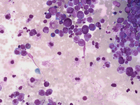 Mast-cell-Leukemia