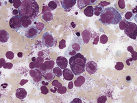 Mast cell Leukemia