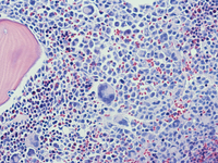 Mast-cell-Leukemia