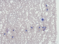 Mast cell Leukemia