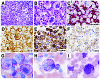 Aleukemic mast cell leukemia associated with chronic myelomonocytic leukemia and chronic lymphocytic leukemia