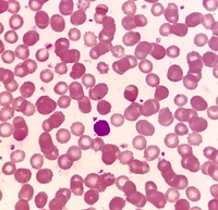 Peripheral blood film shows normal RBC density with normocytic normochromic cells, few acanthocytes and fewer target cells.