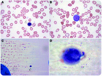 Unusual finding of a megakaryocyte in a peripheral blood smear