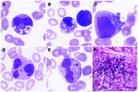 Talaromyces marneffei and dysplastic neutrophils on blood smear in newly diagnosed HIV