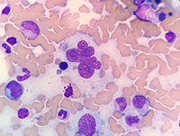 Hodgkin/Reed-Sternberg cell (Wright stain)