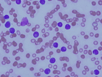 Figure 1: Peripheral blood smear at 50 x magnification