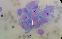 Adenocarcinoma 1