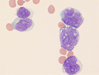 Mantle cell lymphoma CSF