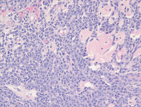 Primary cutaneous DLBCL, leg type