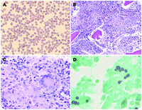 Unusual cause of infant pancytopenia granulomatous bone marrow lesion