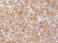 CLL (ZAP70)
