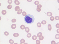 LGL - Large granular lymphocyte