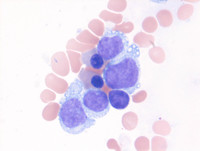 Marrow BPDCN blasts