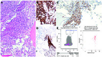 Systemic mastocytosis with concurrent multiple myeloma