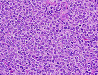 LBCL-with-IRF4-HE-high-400x