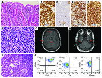 Monomorphic epitheliotropic intestinal T-cell lymphoma involving the central nervous system