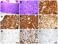 Diffuse large B-cell lymphoma with strong aberrant expression of CD31