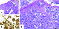 Pautrier-like microabscesses in the tonsil