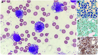 Leukemic-phase progression of aleukemic mast cell leukemia