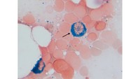 Acute Undifferentiated Leukemia myeloperoxidase (MPO) reaction