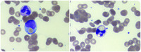 Paroxysmal cold hemoglobinuria with acute renal failure