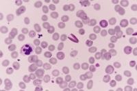 Falciparum-Gametocytes and Ring stages