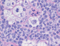 Lacunar Cells in Classical Hodgkin Lymphoma