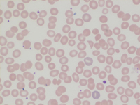 Peripheral Blood with Multiple Schistocytes