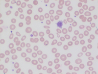 Bone Marrow Fibrosis