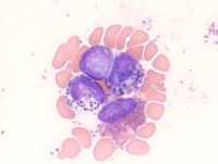 Acute Myeloid Leukemia with inv(16)