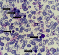 Presence of nucleated RBCs (NRBCs) in peripheral blood smear 1