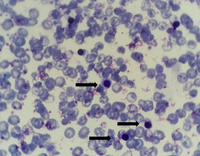 Presence of nucleated RBCs (NRBCs) in peripheral blood smear 2