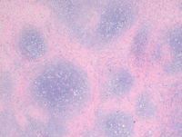 Classical Hodgkin lymphoma, nodular sclerosis subtype