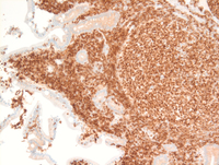 BCL2-Duodenal-follicular-lymphoma