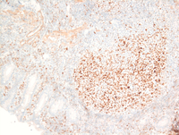 BCL6-Duodenal-follicular-lymphoma