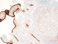 CD10-Duodenal-follicular-lymphoma