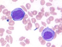 Monoblasts in peripheral blood