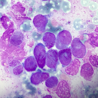 Acute Promyelocytic Leukaemia With T 15 17 1