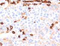 EBVPlasmablastic-lymphomaCD45
