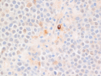 EBVPlasmablastic-lymphomaCD79a
