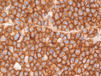 EBVPlasmablastic-lymphomaCD138