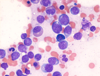 AML-CEBPA-Aspirate