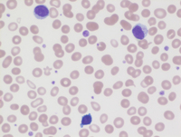 MDS with ring sideroblasts