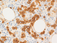 Intravascular-DLBCLBCL2-IHC