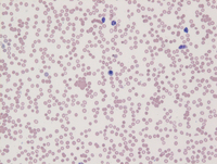 Intravascular DLBCL-Blood